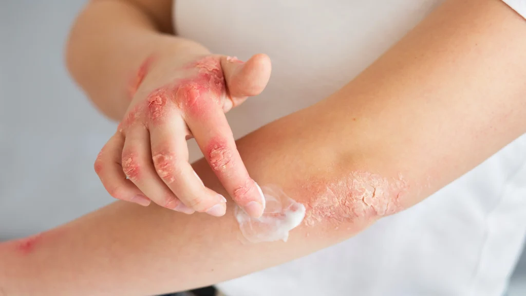 Atopic Eczema: Top New Treatments You Should Know